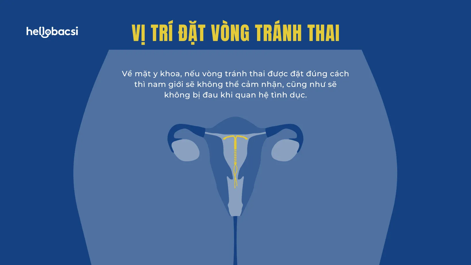 Quan hệ sau khi đặt vòng tránh thai