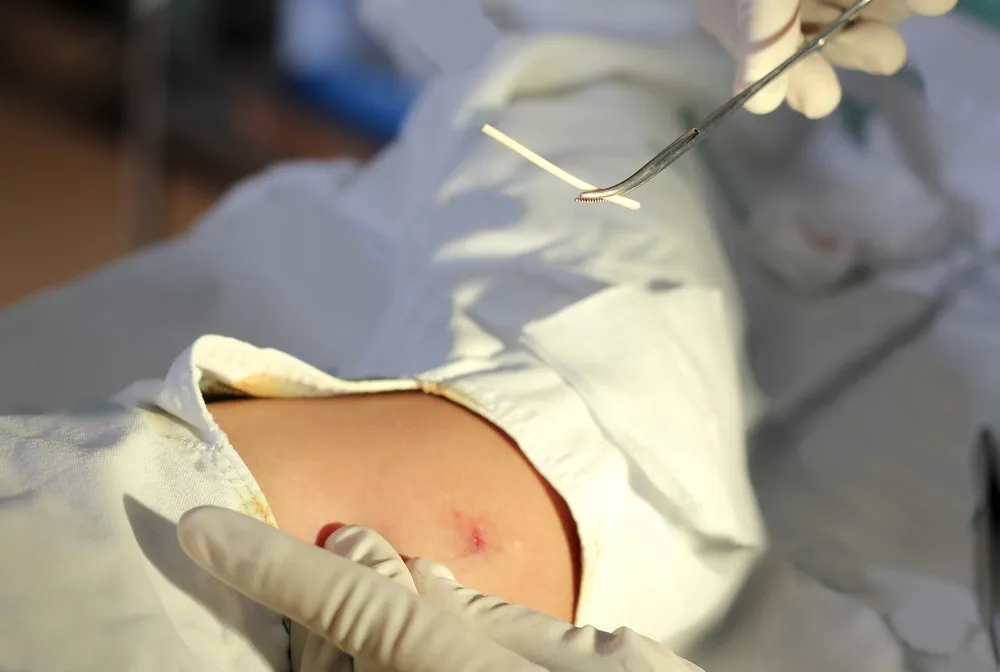 Cấy que tránh thai