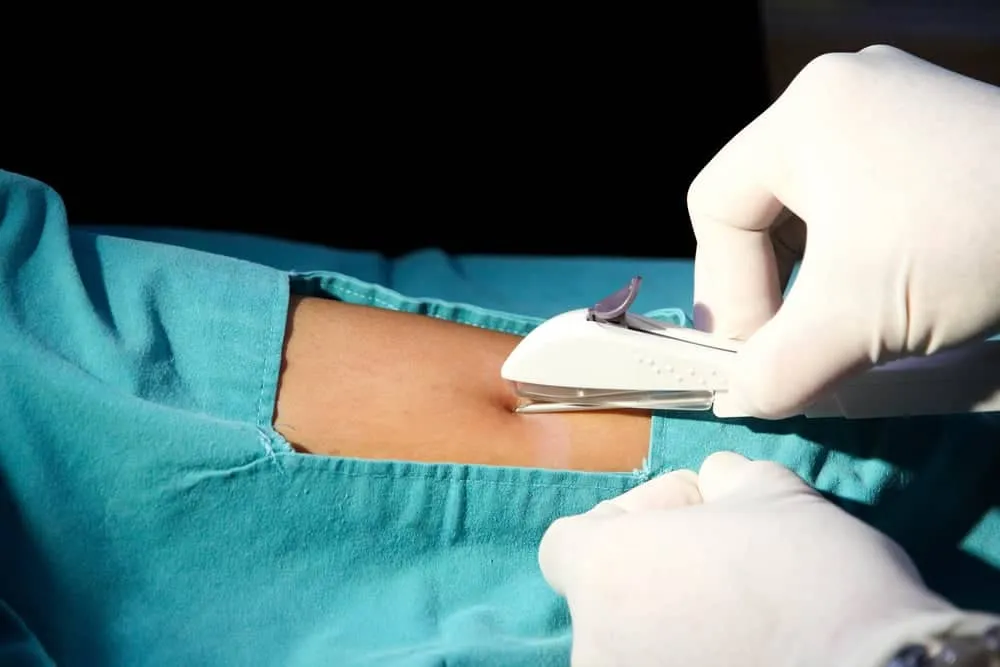 Quan hệ khi cấy que tránh thai